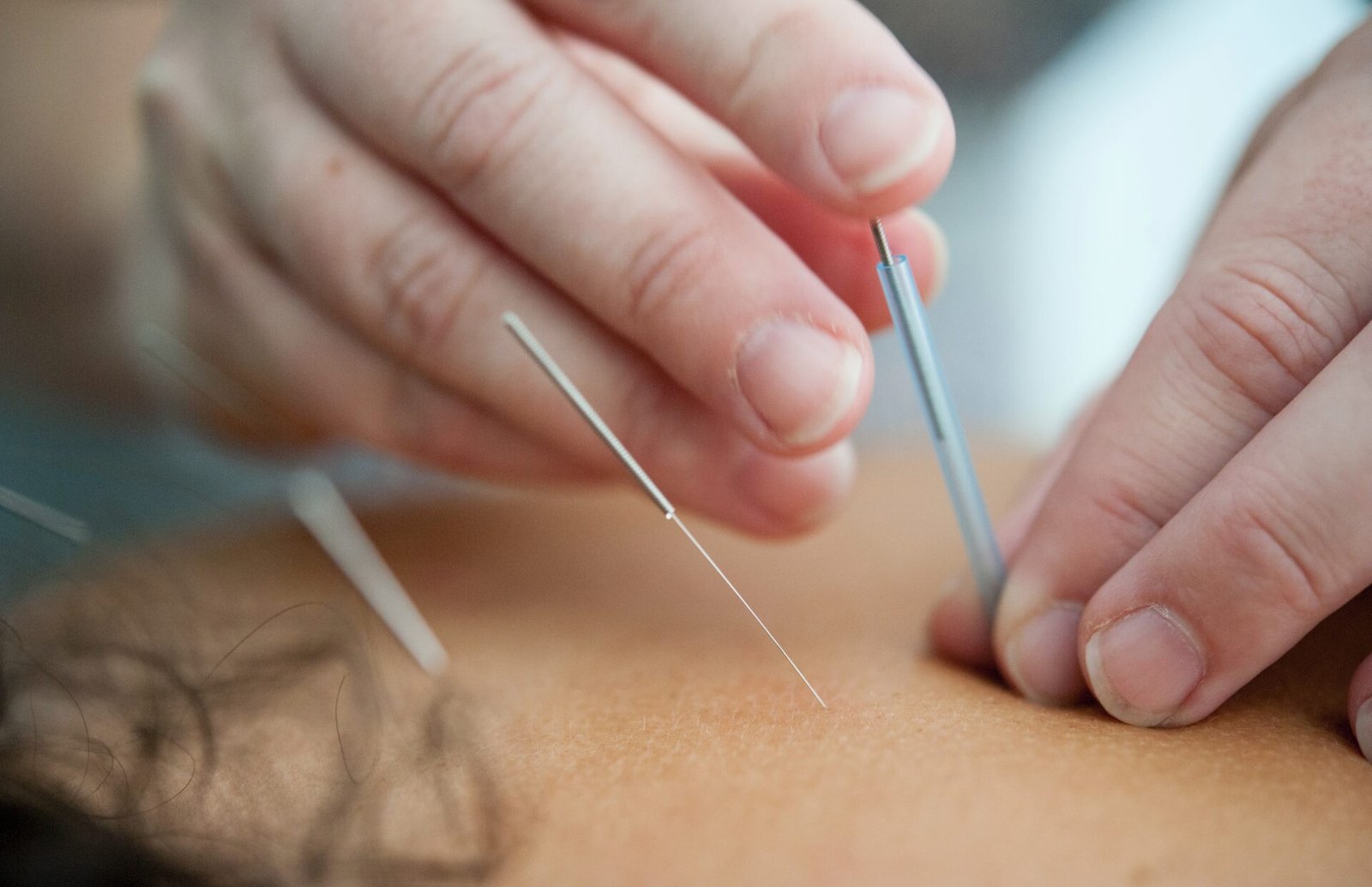 Acupuncture needles being inserted