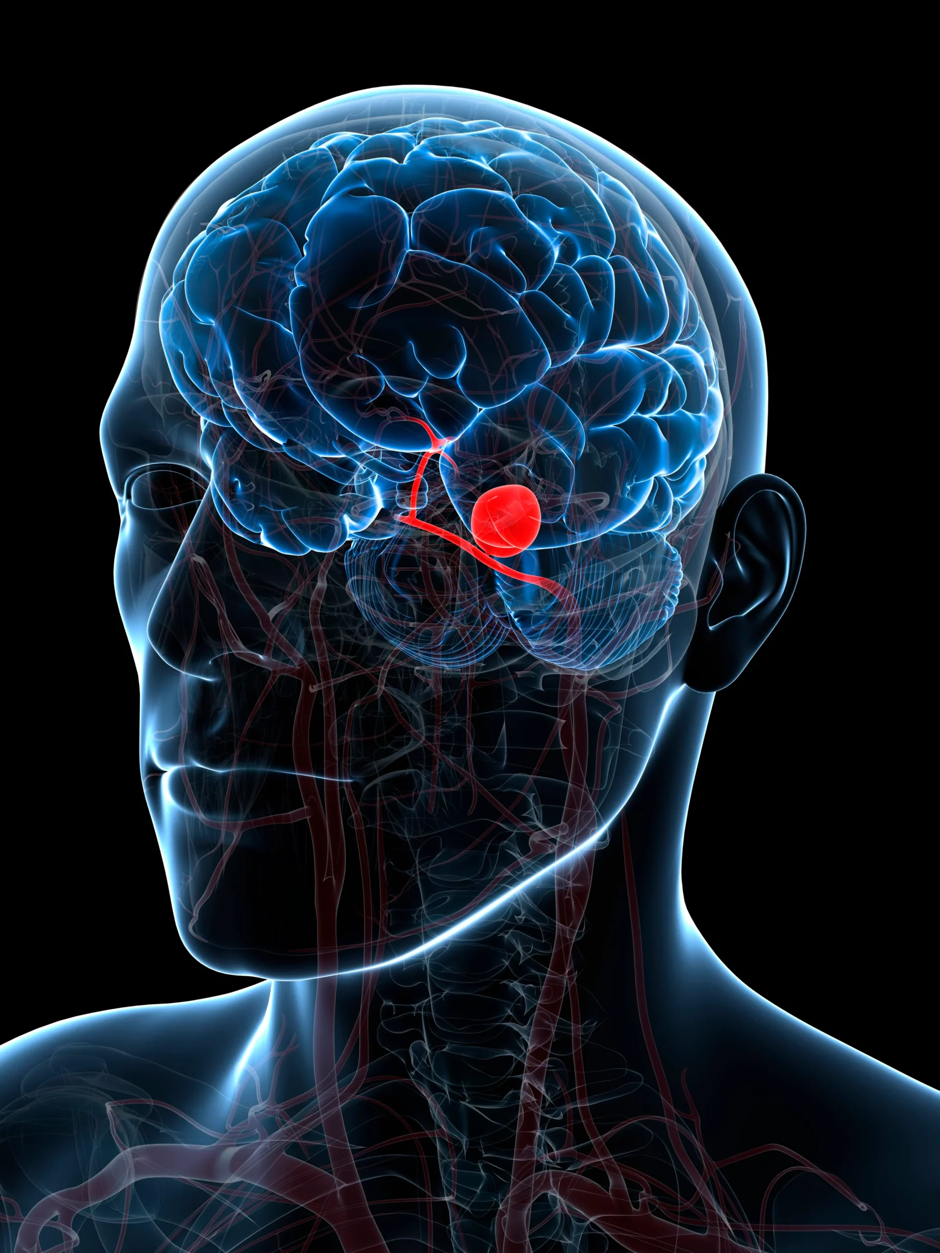 brain aneurysm